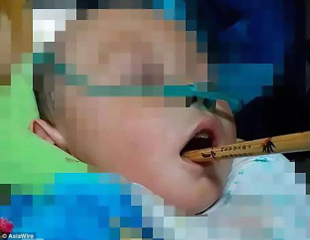 Bé 16 tháng nuốt gọn chiếc bấm móng tay vào bụng vì nghĩ rằng mẹ đùa với mình - 4