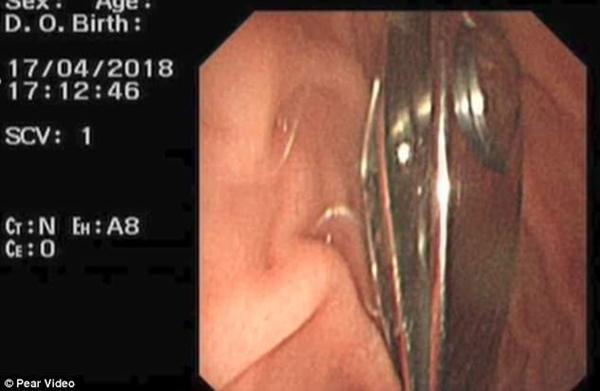 Bé 16 tháng nuốt gọn chiếc bấm móng tay vào bụng vì nghĩ rằng mẹ đùa với mình - 3