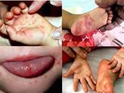 Làm mẹ - Cách tăng cường sức đề kháng hiệu quả để phòng bệnh mùa hè cho trẻ