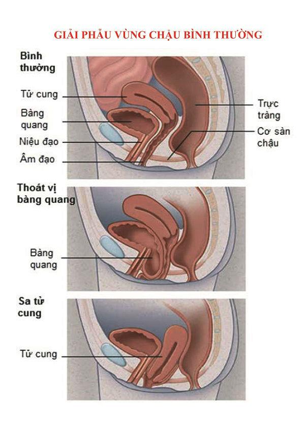 Són tiểu không kiểm soát, bác sĩ cảnh báo chị em đừng có chủ quan kẻo nguy sau này - 2