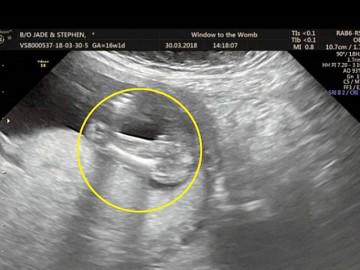 Mẹ bầu hốt hoảng khi phát hiện hình ảnh siêu âm thai giống hệt... "cậu nhỏ"