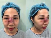 Đẹp - Làm đẹp bằng phương pháp tiêm filler: Cẩn thận “tiền mất, tật mang” khi ham giá rẻ