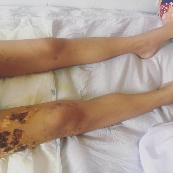 Nữ sinh liệt nửa người sau tai nạn thảm khốc: Từng có ý định tự tử để mẹ đỡ khổ - 3