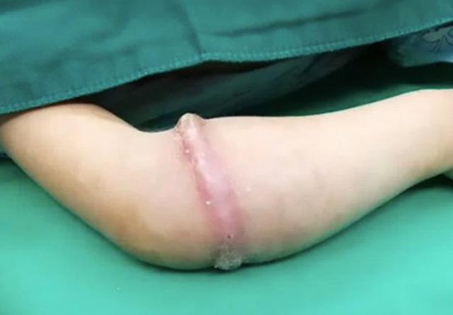 Bé gái 4 tuổi suýt mất một bên tay chỉ vì vật dụng nhỏ xíu nhà nào cũng có - 1