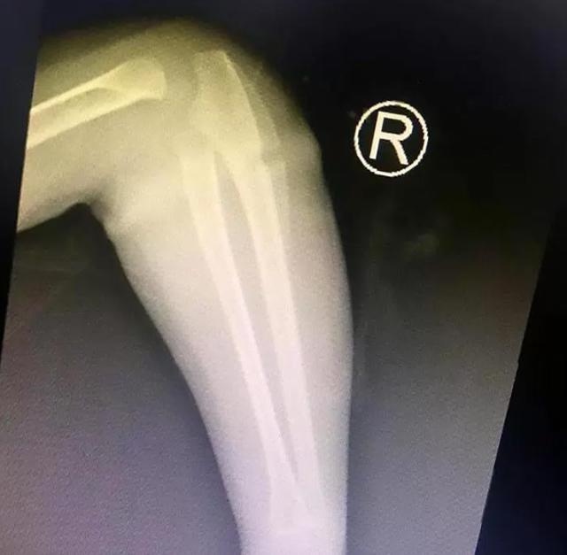 Bé gái 4 tuổi suýt mất một bên tay chỉ vì vật dụng nhỏ xíu nhà nào cũng có - 2