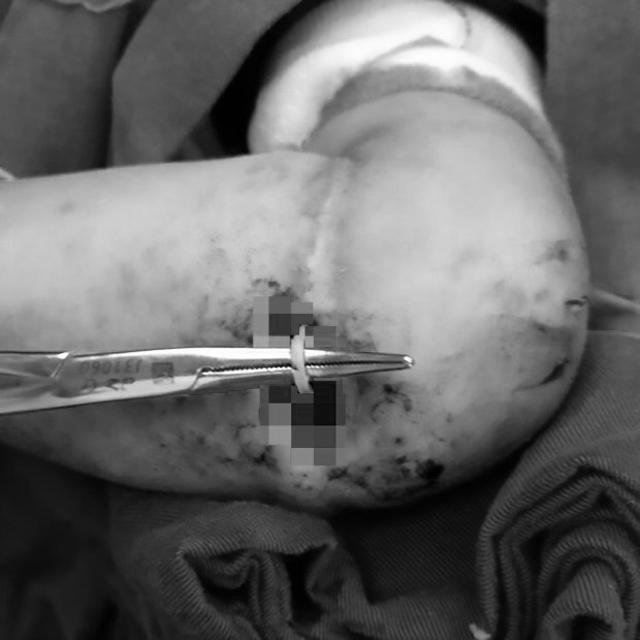 Bé gái 4 tuổi suýt mất một bên tay chỉ vì vật dụng nhỏ xíu nhà nào cũng có - 3