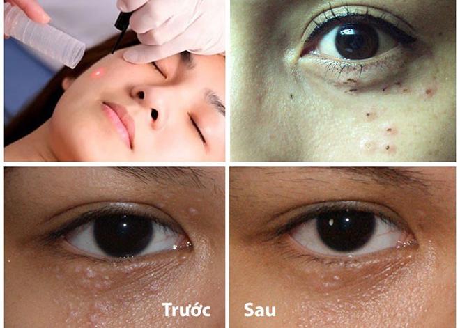 Nếu gặp phải những loại mụn này, đừng dại động vào mà hãy để chúng “tự sinh tự diệt” - 1