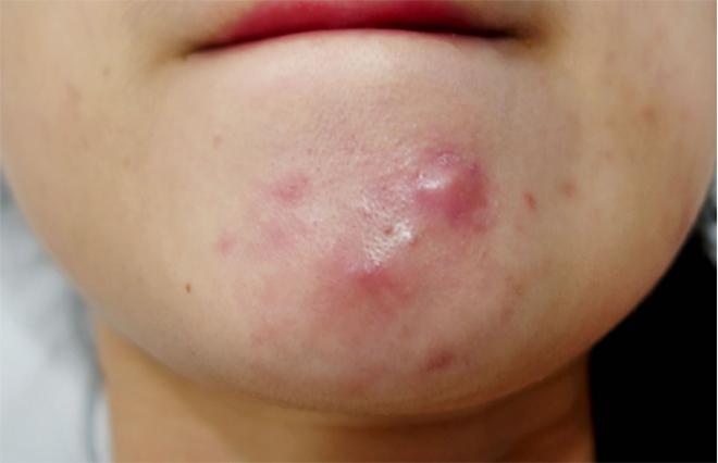 Nếu gặp phải những loại mụn này, đừng dại động vào mà hãy để chúng “tự sinh tự diệt” - 2