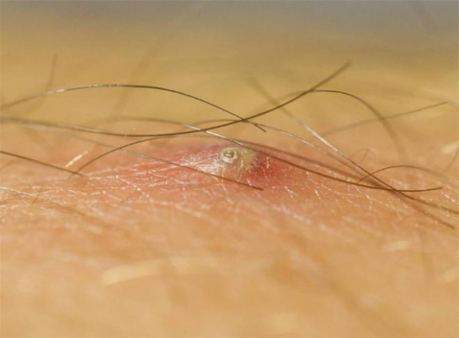 Nếu gặp phải những loại mụn này, đừng dại động vào mà hãy để chúng “tự sinh tự diệt” - 5