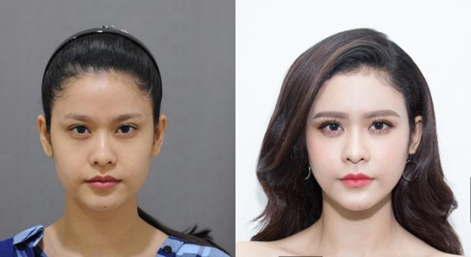 Mở rộng khoé mắt - xu hướng phẫu thuật 2018 đã lan rộng đến Việt Nam như thế nào? - 1