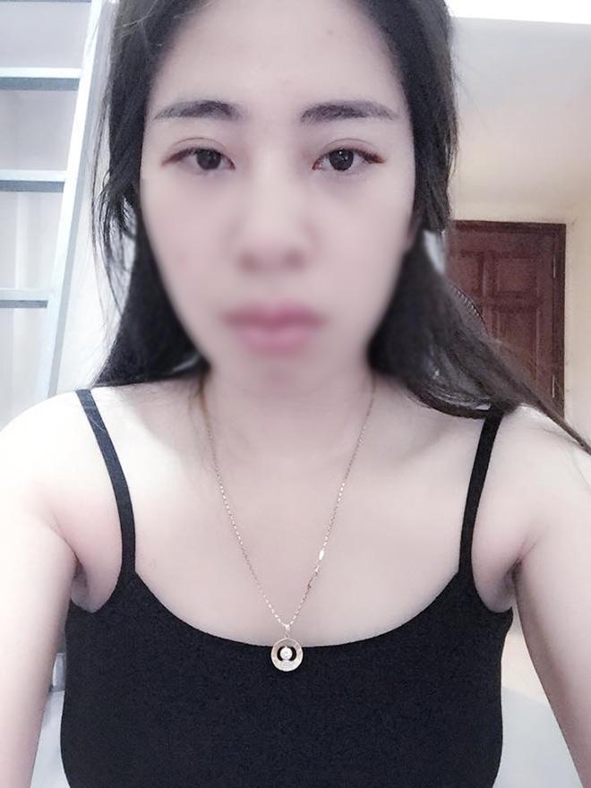 Mở rộng khoé mắt - xu hướng phẫu thuật 2018 đã lan rộng đến Việt Nam như thế nào? - 10