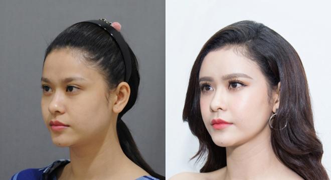 Mở rộng khoé mắt - xu hướng phẫu thuật 2018 đã lan rộng đến Việt Nam như thế nào? - 2