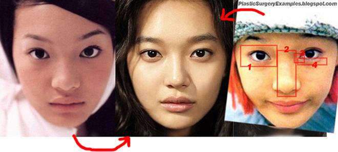 Mở rộng khoé mắt - xu hướng phẫu thuật 2018 đã lan rộng đến Việt Nam như thế nào? - 3