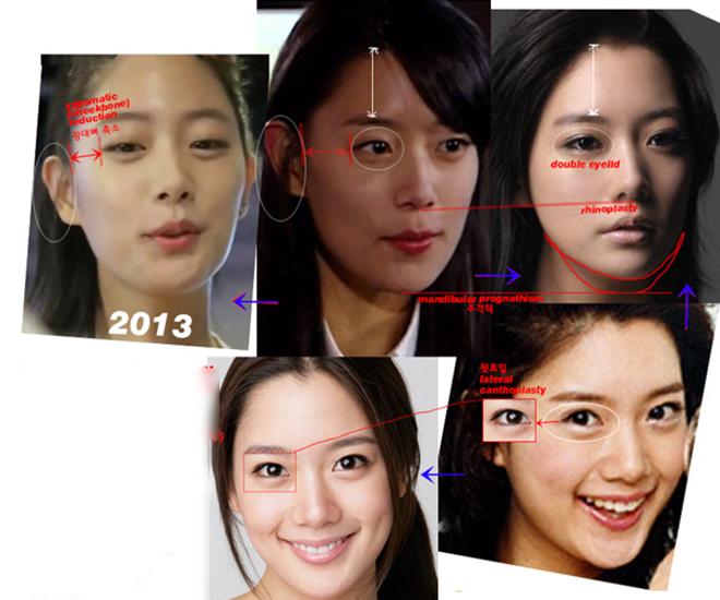 Mở rộng khoé mắt - xu hướng phẫu thuật 2018 đã lan rộng đến Việt Nam như thế nào? - 4