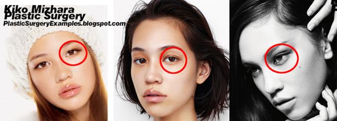 Mở rộng khoé mắt - xu hướng phẫu thuật 2018 đã lan rộng đến Việt Nam như thế nào? - 5