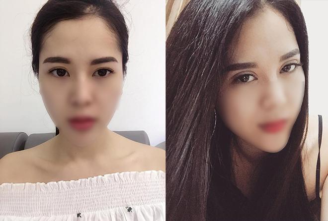 Mở rộng khoé mắt - xu hướng phẫu thuật 2018 đã lan rộng đến Việt Nam như thế nào? - 8