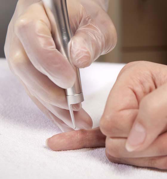 Nếu còn chưa biết mụn cóc có nguy hiểm không, thì hãy cập nhật ngay các kiến thức này - 6