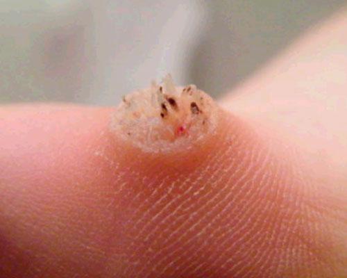 Nếu còn chưa biết mụn cóc có nguy hiểm không, thì hãy cập nhật ngay các kiến thức này - 1