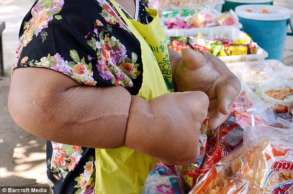 Người phụ nữ có đôi tay amp;#34;khủngamp;#34; nhất hành tinh, bác sĩ lắc đầu nói amp;#34;vô phương cứu chữaamp;#34; - 2