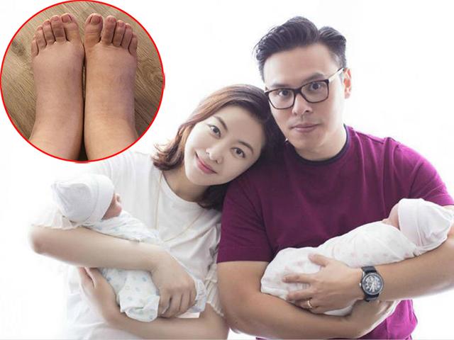 Sinh đôi con gái cho đại gia, chân dài Hong Kong lộ đôi chân sưng phù đáng sợ