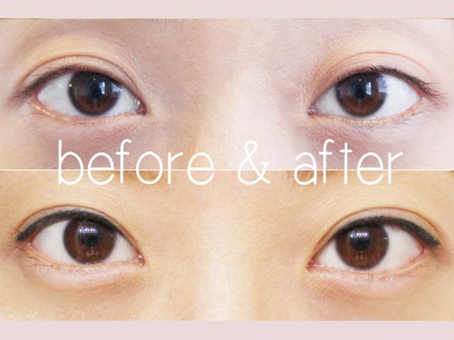 Thích mắt to nhờ cắt mí chưa đủ, chị em còn muốn mắt dài nhờ phẫu thuật mở tròng mắt!