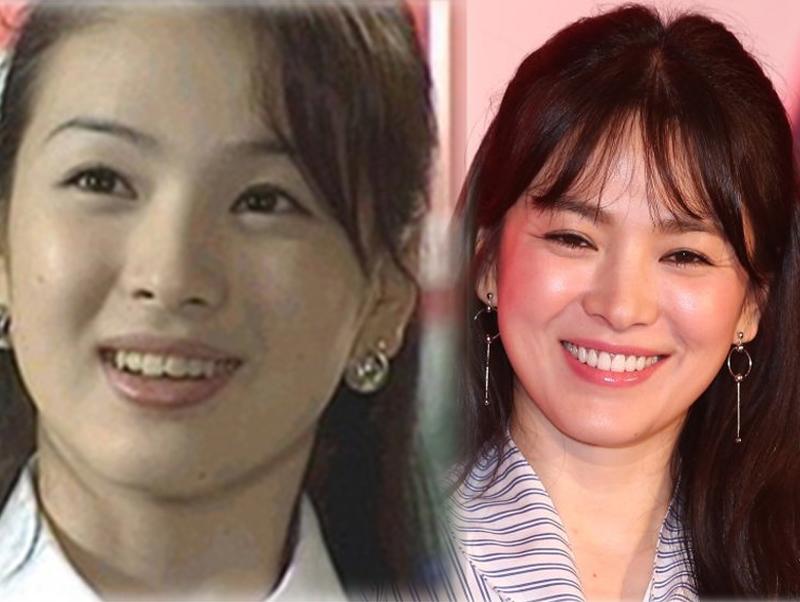 Song Hye Kyo đã trở thành biểu tượng nhan sắc sau khi chỉnh răng.
