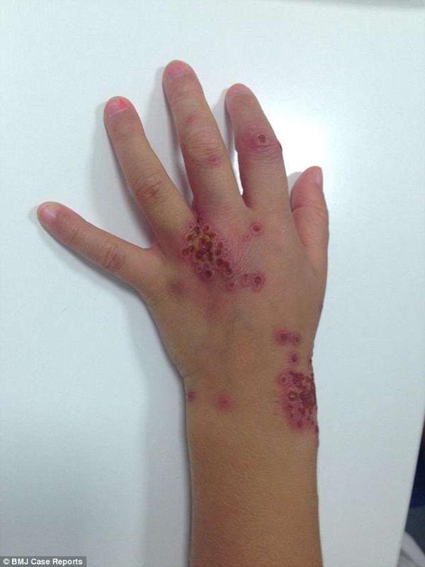 Vì nụ hôn của người bố, con gái 3 tuổi bị lở loét, rộp mụn nước khắp người - 2