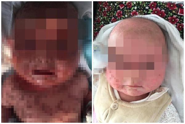 Vì nụ hôn của người bố, con gái 3 tuổi bị lở loét, rộp mụn nước khắp người - 3