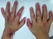 Làm mẹ - Vì nụ hôn của người bố, con gái 3 tuổi bị lở loét, rộp mụn nước khắp người
