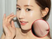 Đẹp - Xoá sẹo lồi cấp tốc nhờ 3 nguyên liệu rẻ, nhanh, gọn có thể thực hiện ngay tại nhà