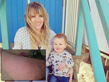 Mẹ bầu khổ sở vì phát ban suốt thai kỳ, sau sinh 1 tháng vẫn không được ôm con