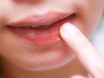 Với 5 ngàn đồng, chị em có ngay cách dưỡng môi bằng mật ong khỏi cần bôi son