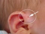 Làm mẹ - 2% trẻ sơ sinh có đặc điểm này ở tai, mẹ nên chăm sóc kĩ