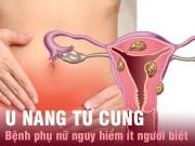 Sức khỏe - U nang tử cung - bệnh phụ nữ nguy hiểm chị em cần nắm rõ để chữa ngay còn kịp