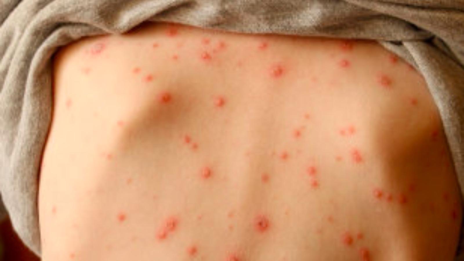 7 thắc mắc phổ biến nhất về bệnh thủy đậu mà ai cũng muốn biết - Sức khỏe