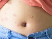 Sức khỏe - 7 thắc mắc phổ biến nhất về bệnh thủy đậu mà ai cũng muốn biết nhưng ngại hỏi bác sĩ