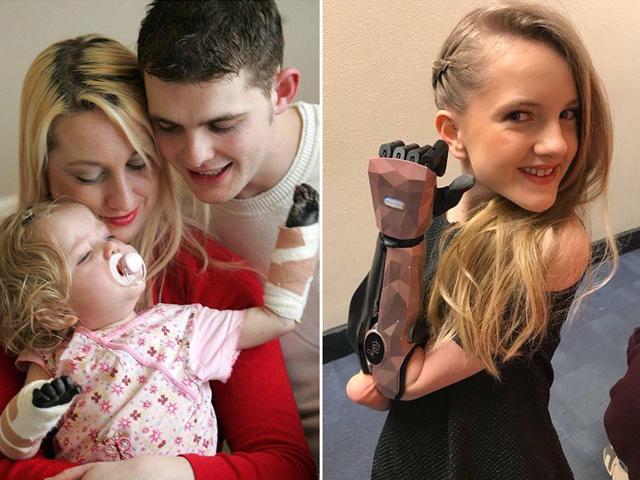 Sự thay đổi kinh ngạc sau 10 năm của cô bé từng bị viêm màng não phải cắt bỏ tay