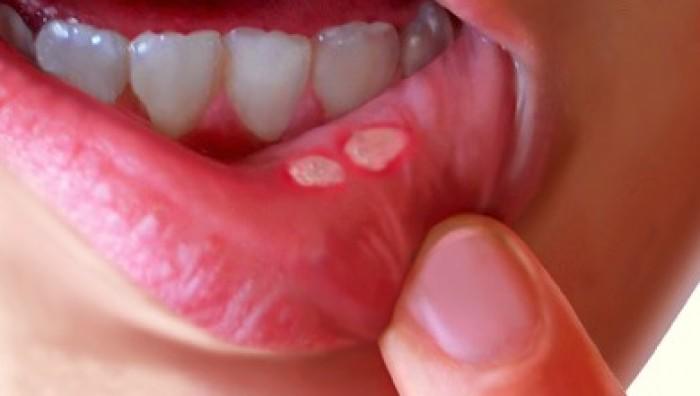 12 cách chữa nhiệt miệng cực kỳ hiệu quả - 1