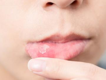 12 cách chữa nhiệt miệng cực kỳ hiệu quả