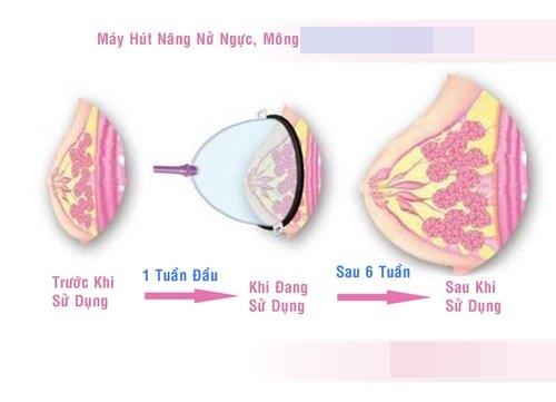 Tám chuyện dao kéo: nâng ngực bằng máy hút không mổ xẻ, hiệu quả tức thì? - 3