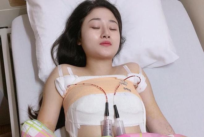 Tám chuyện dao kéo: nâng ngực bằng máy hút không mổ xẻ, hiệu quả tức thì? - 5