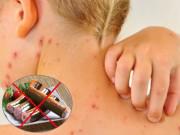 Sức khỏe - Bệnh thủy đậu kiêng gì và nên ăn gì để nhanh khỏi