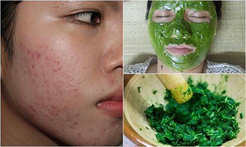 Chạy ra chợ mua nắm rau má về xay nhuyễn rồi đắp lên mặt, sẹo lõm đến mấy cũng khỏi - 5
