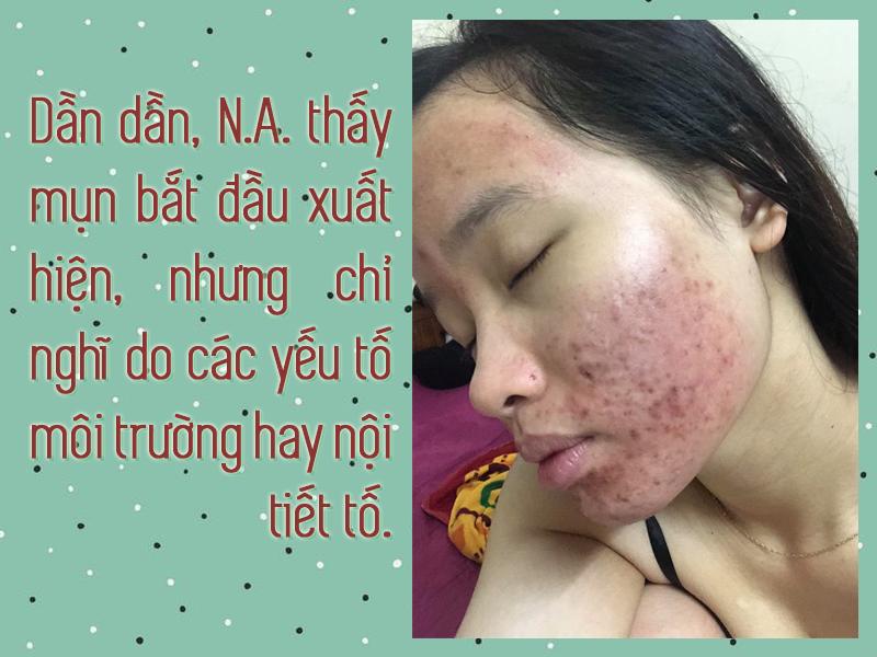 Sau 2 tháng liên tục sử dụng, da mặt cô bạn bắt đầu bị mụn hoành hành.
