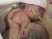 Bà bầu - Cay mắt với hành động của bé sinh non khi em gái song sinh sắp ra đi mãi mãi