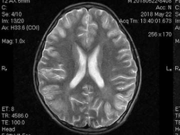 Uống hơn 1 lít rượu, bé trai phải nhập viện vì hôn mê, não bị tổn thương nghiêm trọng