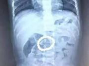 Sức khỏe - Hình chụp X-quang dạ dày bé 14 tháng tuổi khiến phụ huynh "tá hỏa" vì món đồ chơi của con