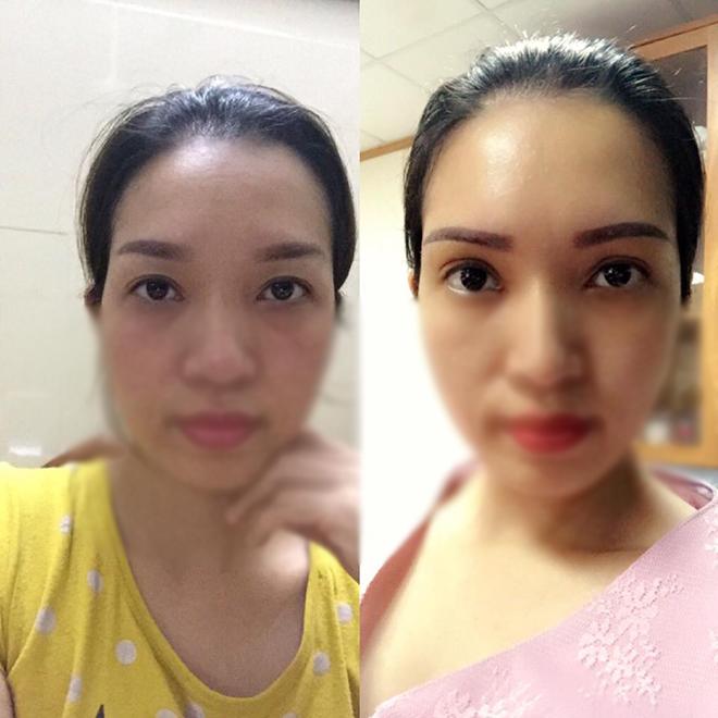 Nâng chân mày cải thiện nếp nhăn và mí sụp nhưng không chỉ dành cho phụ nữ trung niên! - 10