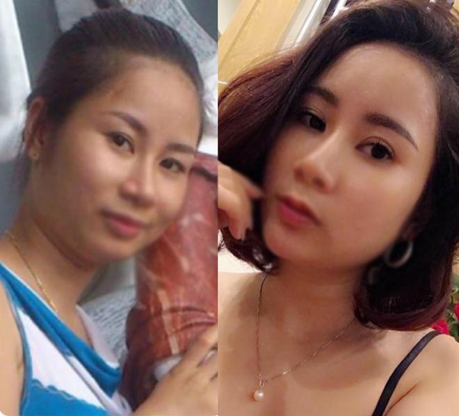 Nâng chân mày cải thiện nếp nhăn và mí sụp nhưng không chỉ dành cho phụ nữ trung niên! - 11