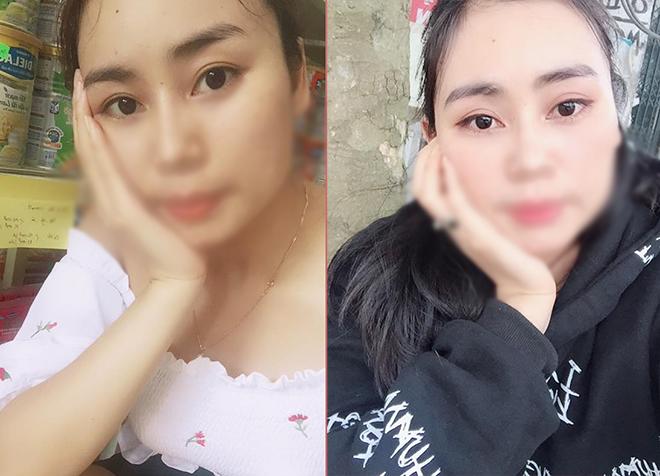 Nâng chân mày cải thiện nếp nhăn và mí sụp nhưng không chỉ dành cho phụ nữ trung niên! - 9